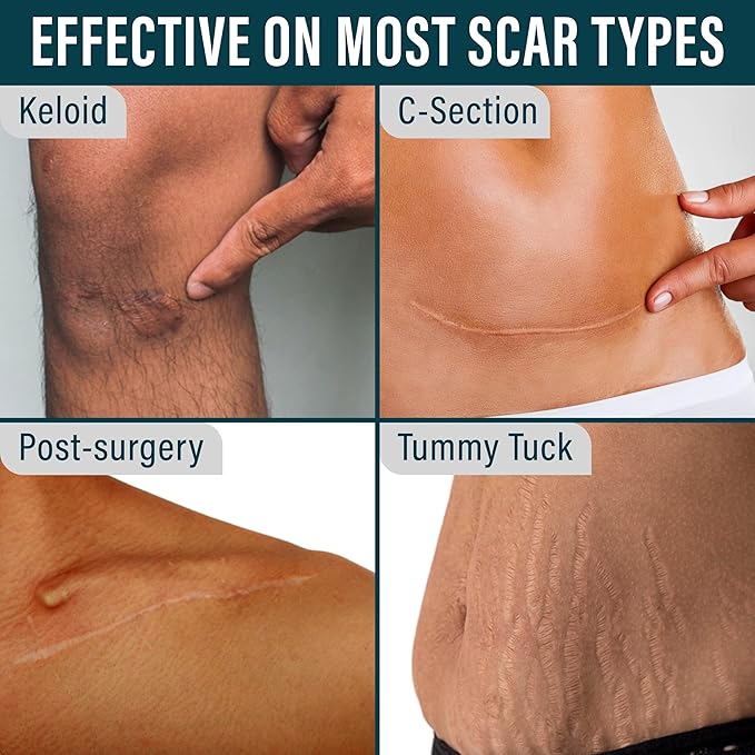 The Scar Cream Lie: Why 99% of Treatments Can't Work (And the One That Finally Does)