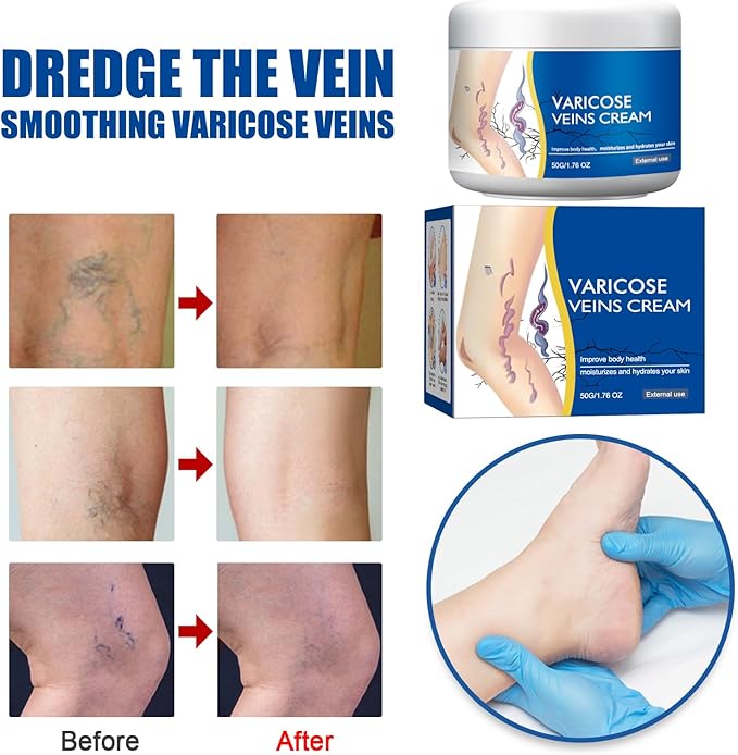Varicose Veins Treatment for Legs, Spider Varicose Veins Relief Cream, Skin Cream for Legs 50g/1
