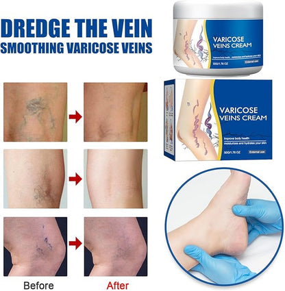 Varicose Veins Treatment for Legs, Spider Varicose Veins Relief Cream, Skin Cream for Legs 50g/1