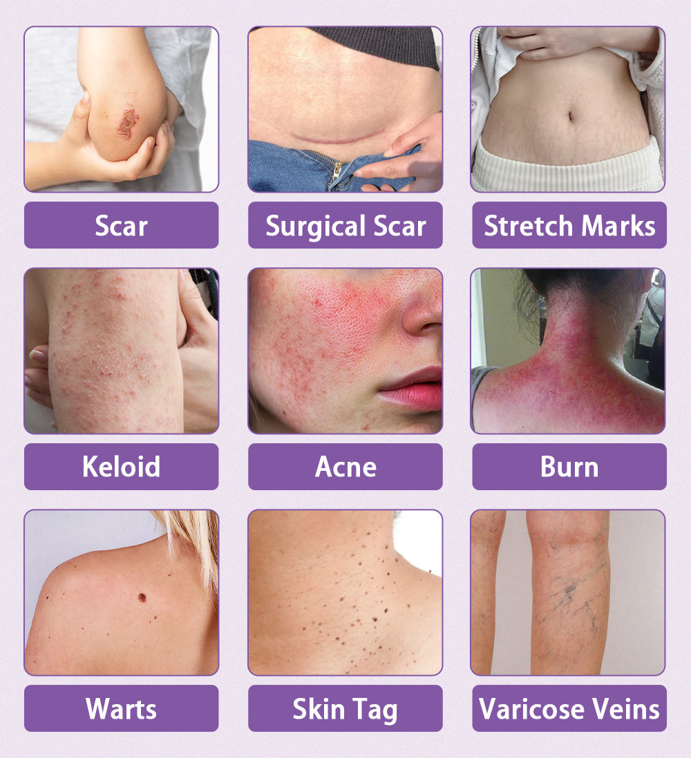 The Scar Cream Lie: Why 99% of Treatments Can't Work (And the One That Finally Does)